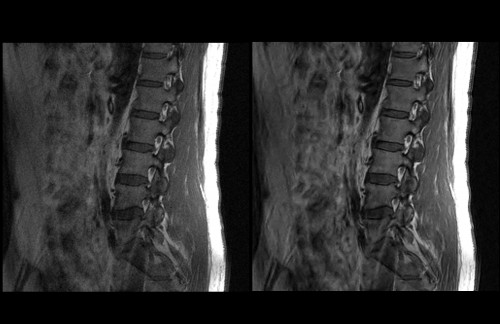 Sapheneia MR Spine Altaire Pass 2 before and after