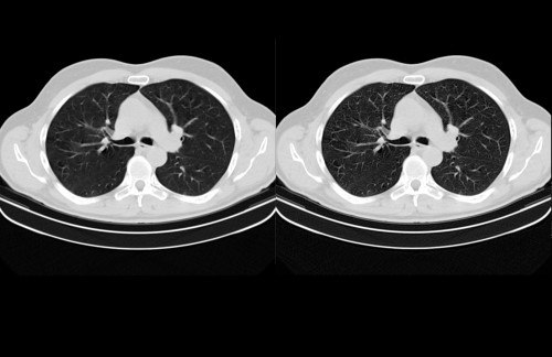Sapheneia CT Lung 20 mAs