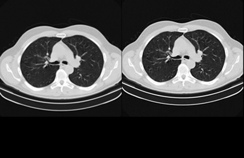 Sapheneia-CT-Lung-3